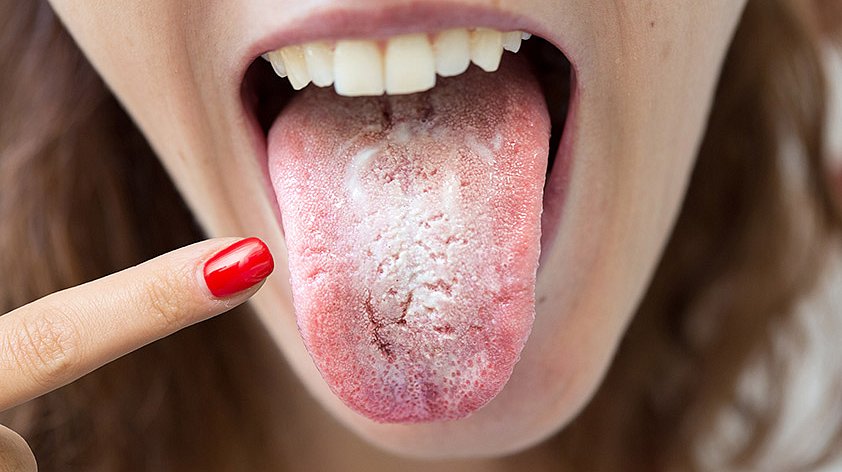  Oral Candidiasis & Mucosal Lesions